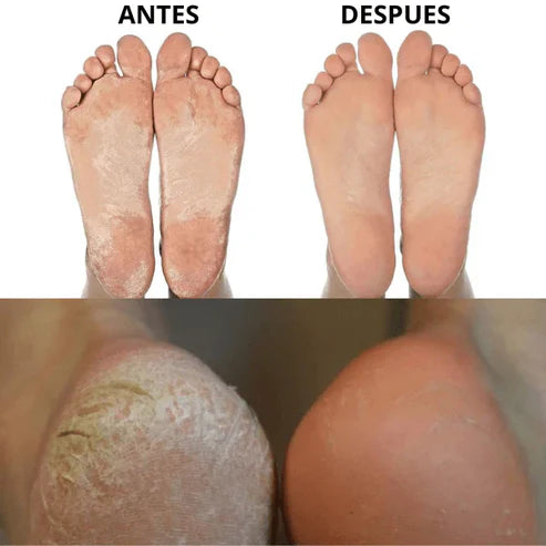 FootCare Pro™ – Elimina Callos