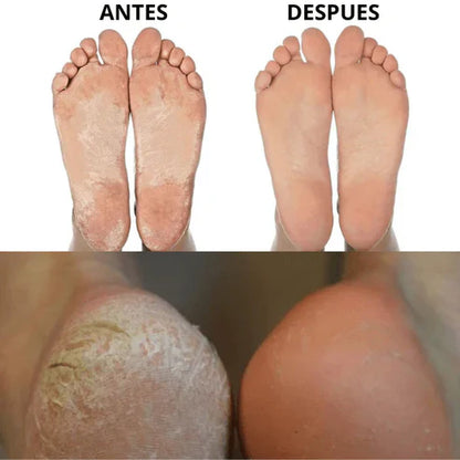 FootCare Pro™ – Elimina Callos